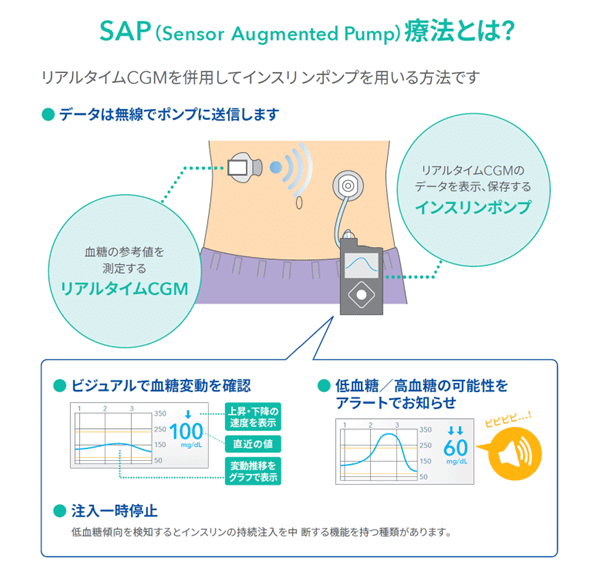 SAP療法